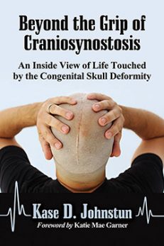 Beyond the Grip of Craniosynostosis